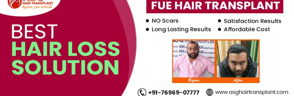 ASG Hair TRansplant Cover Image